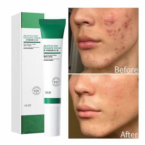 CREMA PERFILADORA ACIDO SALICILICO BIOAQUA